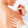Cauterización de lunares, pecas, verrugas