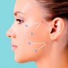 Hilos tensores y perfilamiento facial 